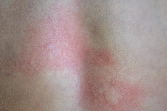 leczenie rumienia Białystok